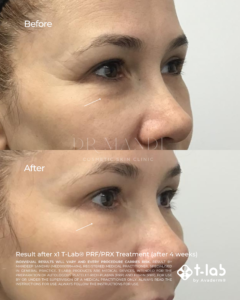 T-Lab® PRF Result 16
